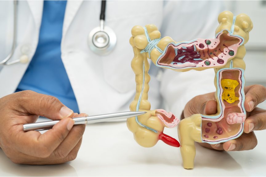 A doctor pointing to the appendix on an anatomical model of the large bowel